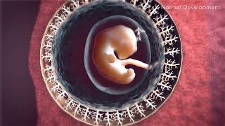 Animated Portrayal of Placenta Accreta Spectrum [upl. by Tyre]