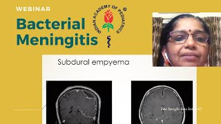 Bacterial Meningitis IAP Thiruvananthapuram Pediatric Webinar [upl. by Dnumyar]