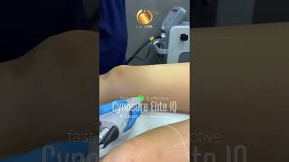 Laser Hair Removal  Cynosure Elite IQ [upl. by Noslien223]