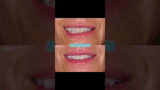 Botox can fix a crooked smile [upl. by Goddard]