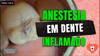 ANESTESIA FUNCIONA EM CANAL DE DENTE INFLAMADO Parte 14 Endolovers [upl. by Tyre]