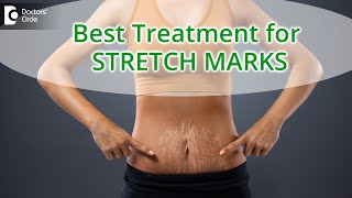 10 Ways to Get Rid of Stretch Marks  Stretch Marks Removal  Dr Divya Sharma  Doctors Circle [upl. by Ailes]