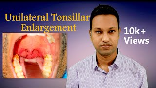 Unilateral Tonsillar Enlargement Aetiologies and Evaluation [upl. by Ragucci]