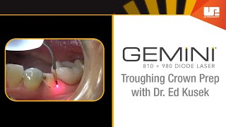 Troughing Crown Prep  How To Use the Gemini™ Laser [upl. by Kester970]