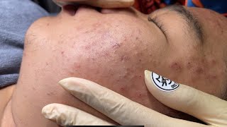 Blackheads amp Whiteheads Removal New 2024  Acne Treatment With Bo Nguyễn Spa 008 [upl. by Culbert]