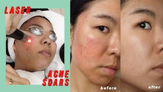 Picosure Laser for Acne Scars amp Hyperpigmentation Before amp After [upl. by Aliuqehs]