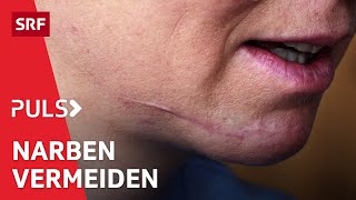 Wunden pflegen mit Narben leben – So hinterlassen Hautverletzungen weniger Spuren  Puls  SRF [upl. by Masha835]