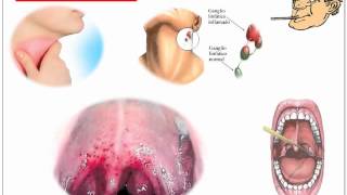 Streptococcus Pyogenes [upl. by Mychal]