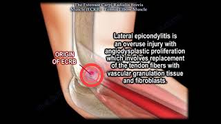 Tennis Elbow Muscle Extensor Carpi Radialis Brevis Everything You Need To Know Dr Nabil Ebraheim [upl. by Hett]