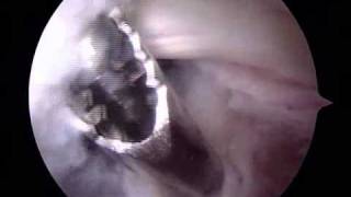 Arthroscopic Removal of Bakers Cyst  ORV  Raymond Whitehead MD [upl. by Eliezer398]