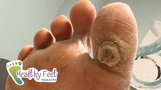 DEEP SATISFYING CALLUS TREATMENT [upl. by Eremihc]