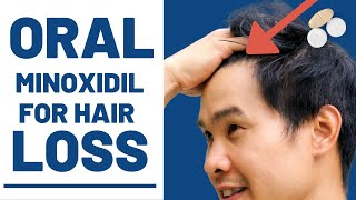 Oral Minoxidil  How Effective Is it REALLY [upl. by Aikimat]