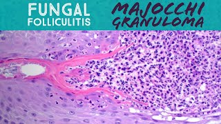 Majocchi granuloma fungal folliculitis by dermatophyte tinea “ringworm” fungus dermatology [upl. by Hajile911]