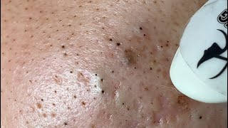 Make your Acne Treatment Huong Da Nang517  acne 2023 [upl. by Favin936]