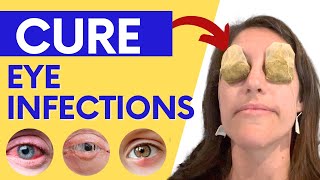 How to Treat Eye Infections Eye Allergies and Pink Eye Naturally at Home [upl. by Birdie79]