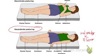 Decerebrate Vs Decorticate Posturing [upl. by Pani]