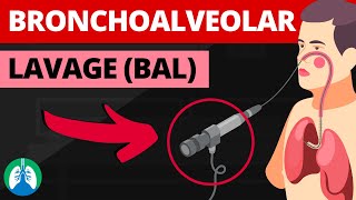 Bronchoalveolar Lavage BAL Medical Definition  Quick Explainer Video [upl. by Hahnert]