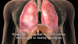 English MAKNA Getting to know Lung Cancer [upl. by Asimaj]