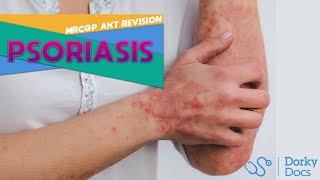 Psoriasis  The MRCGP AKT Exam Revision I Dorky Docs [upl. by Aihsaei]