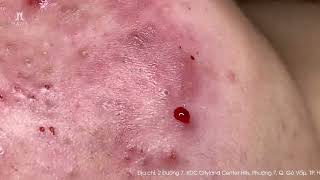 Big Cystic Acne Blackheads Extraction Blackheads amp Milia Whiteheads Removal Pimple Popping [upl. by Nadabas867]