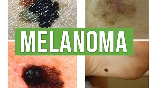 Melanoma vs Benign Melanocytic Nevus  Lecturio Dermatology [upl. by Long49]