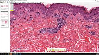 Erythema multiforme [upl. by Gibeon]