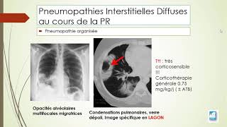 Poumon et polyarthrite rhumatoïde [upl. by Cantone]