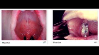 Koplik spots measles rubeola virus [upl. by Ahsinehs]