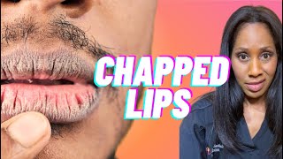 How to Heal Chapped Lips FAST  A Doctor Explains [upl. by Niwled]