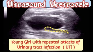 Ultrasound URETROCELE  Case of Young Girl with Repeated UTIs  Urinary Tract Infection [upl. by Wyon]