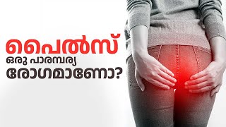 പൈൽസ് ചികത്സ ആയുർവേദത്തിൽ Piles  Hemorrhoids  Piles Treatment  Ayurvedic Cure For Piles  Health [upl. by Mufinella]