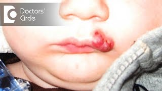 What is Hemangioma of skin  Dr Sachith Abraham [upl. by Aliet]