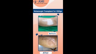 Vitiligo  Vitiligo Awareness  Vitiligo Treatment  Ami Skin Hair Clinic [upl. by Bobbye89]