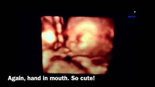 My 17th Week of Pregnancy 3D4D Ultrasound [upl. by Leemaj169]