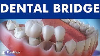 Dental bridge  Fixed dental replacement © [upl. by Cibis76]