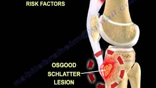 Open Fractures  Everything You Need To Know  Dr Nabil Ebraheim [upl. by Marilee]