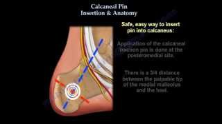 Calcaneal Pin Insertion Anatomy  Everything You Need To Know  Dr Nabil Ebraheim [upl. by Romie]