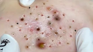 Treat Blackheads and Hidden Acne at Beauty Spa [upl. by Lang]