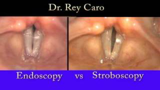 Video Stroboscopy of the Vocal Cords Dr Rey Caro [upl. by Gwenore]