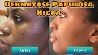 DERMATOSE PAPULOSA NIGRA TRATAMENTO VERRUGAS ll RESULTADOS EM 1 SEMANA COM FOTOS [upl. by Idnak122]