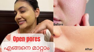 മുഖത്തെ കുഴികൾ മാറ്റി SKIN BRIGHT ആകാൻ  💯 Natural Home Remedy [upl. by Oetsira]