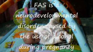 Foetal Fetal Alcohol Syndrome [upl. by Esele]