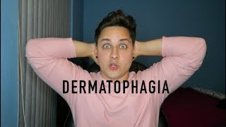 Living with Dermatophagia Skin biting disorder [upl. by Ellebana776]