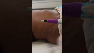 Stretch Marks Inkless Removal Boleyn Treatment Los Angeles 🌍 shorts [upl. by Notwen249]