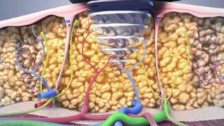 non surgical lipo animation [upl. by Moishe]