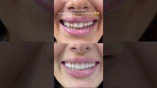 Invisalign and composite bonding by Dr Sonnie 🙌 compositebonding [upl. by Leasa]