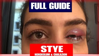 Difference between Stye and Chalazion [upl. by Sullivan933]