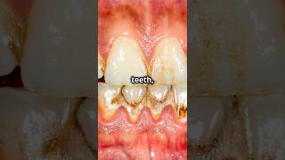 Gingivitis vs periodontistiswhats the difference [upl. by Edmond]