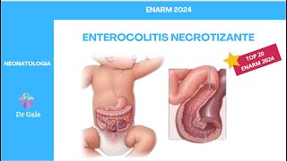 NEONATOLOGÍA  ENTEROCOLITIS NECROTIZANTE  ENARM 2024 [upl. by Maritsa]