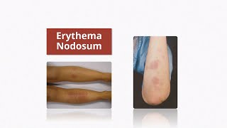 Erythema Nodosum  Causes amp Treatment [upl. by Lawry864]